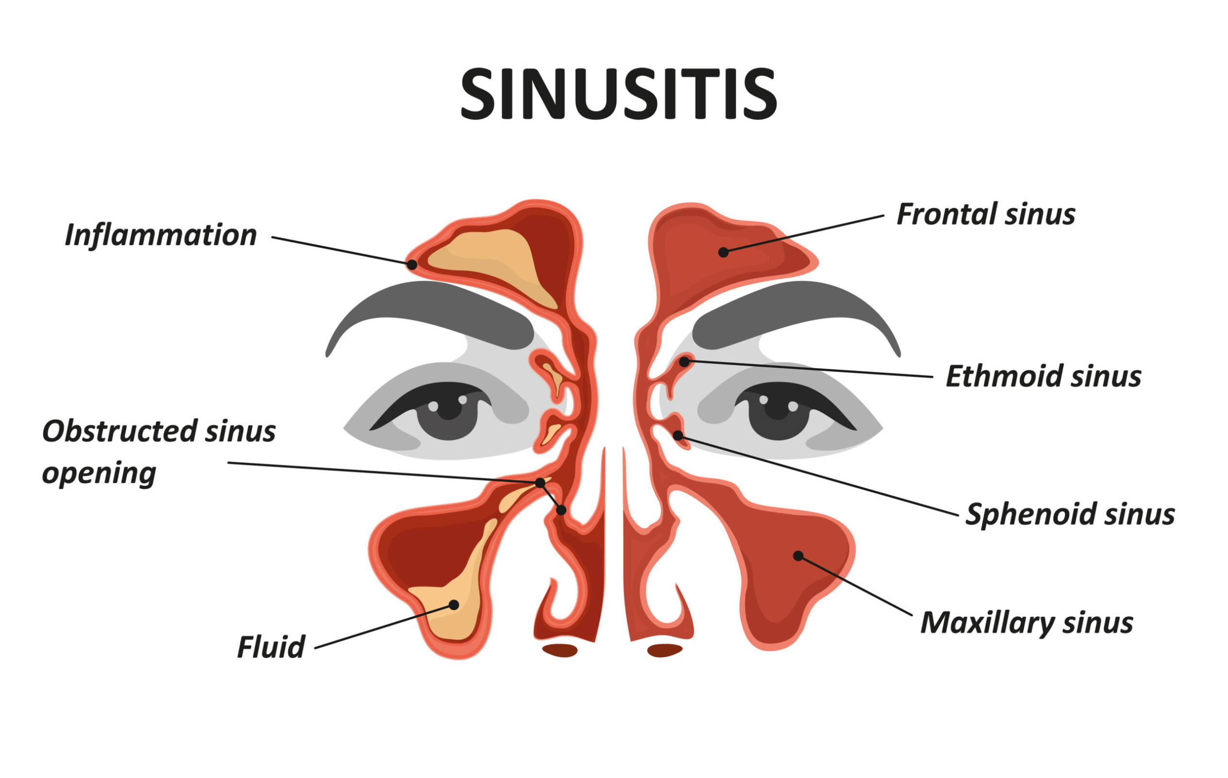 Healthy sinus vs. sinusitis