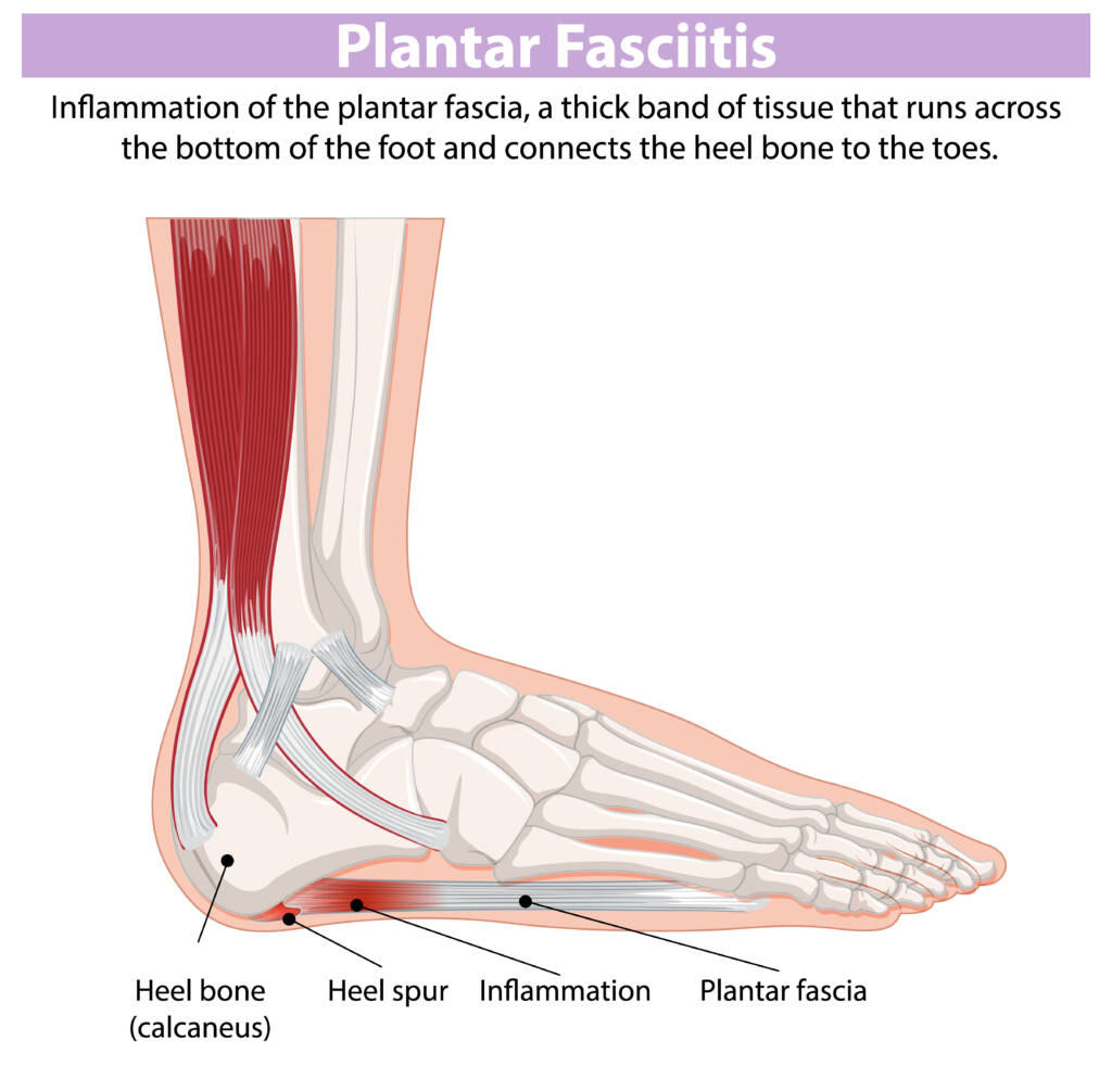 Plantar fasciitis is frequently because you're using your extremities (feet) instead of your proximal regions (abs, glutes)