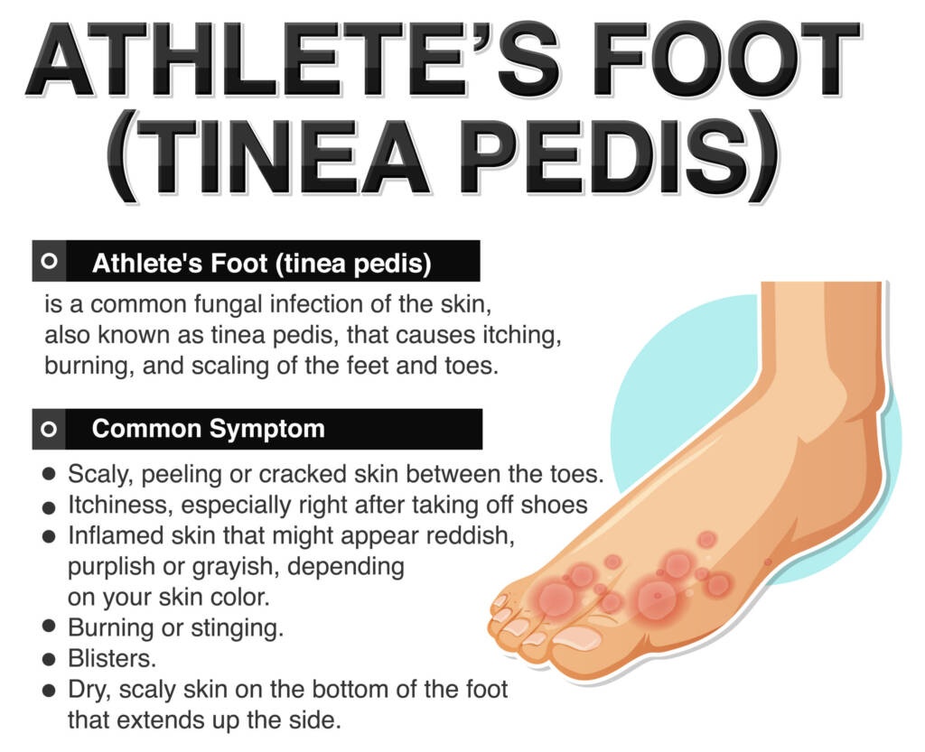 Athlete's foot is not a pleasant topic, but is the result of fungus finding a home in your skin